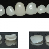 Lentes de Contato Dentais e Laminados Cerâmicos