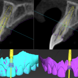 A Nova Era da Implantodontia Digital